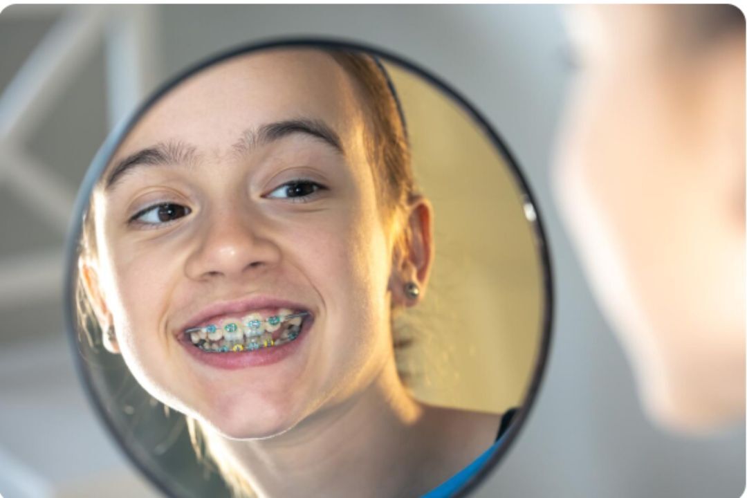 hidden benefits of braces beyond straight teeth